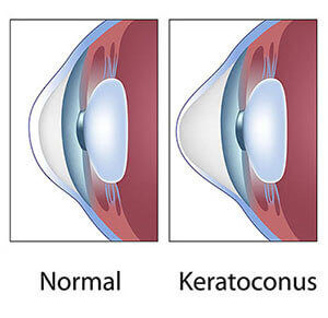 keratoconus diagram