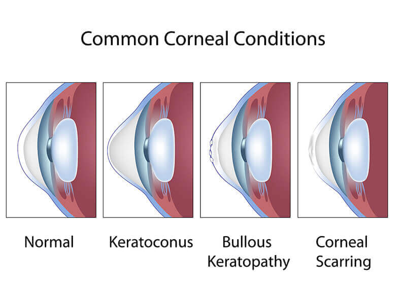 Chart Showing Some Common Corneal Conditions